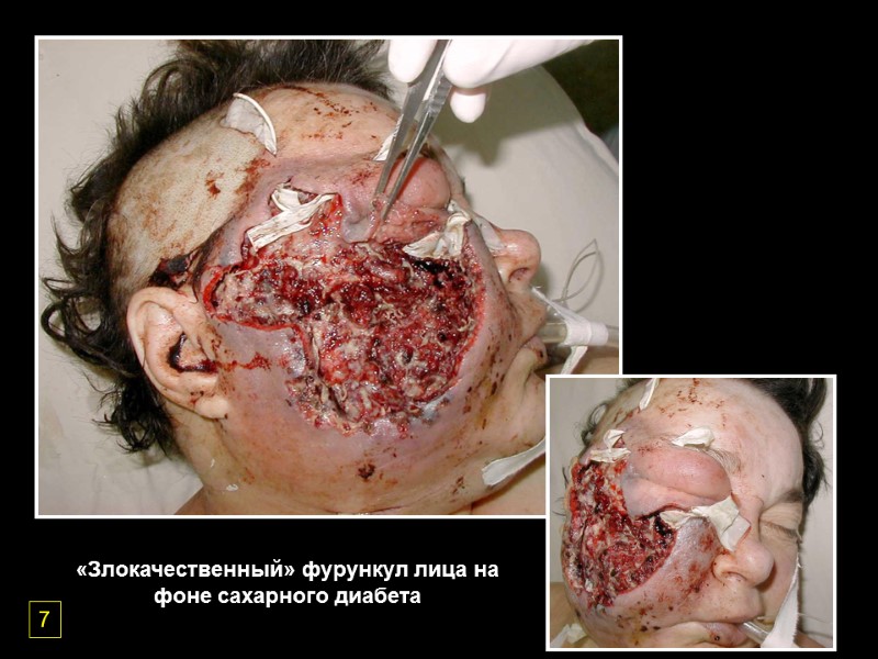 «Злокачественный» фурункул лица на фоне сахарного диабета 7